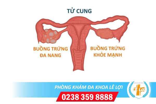 Đa Nang Buồng Trứng, Nguyên Nhân Và Cách Hỗ Trợ Điều Trị Hiệu Quả