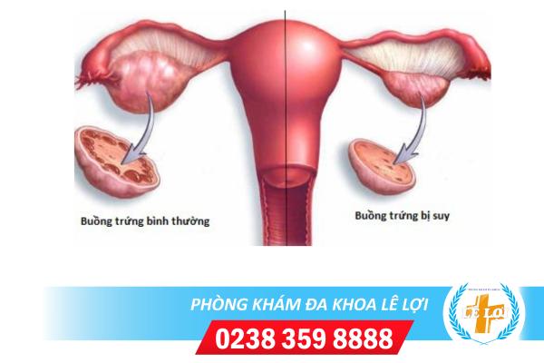 Bạn Có Biết Suy Buồng Trứng Sớm Là Gì Không?