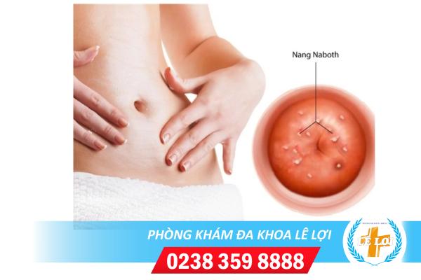 Nang Naboth Cổ Tử Cung Do Đâu Và Phương Pháp Hỗ Trợ Điều Trị Hiệu Quả
