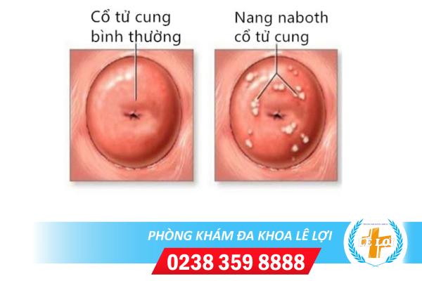 Nang Naboth Cổ Tử Cung Do Đâu Và Phương Pháp Điều Trị Hiệu Quả