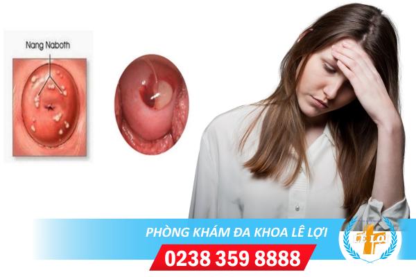 Nhận Biết Bệnh Nang Naboth Cổ Tử Cung Bằng Cách Nào?