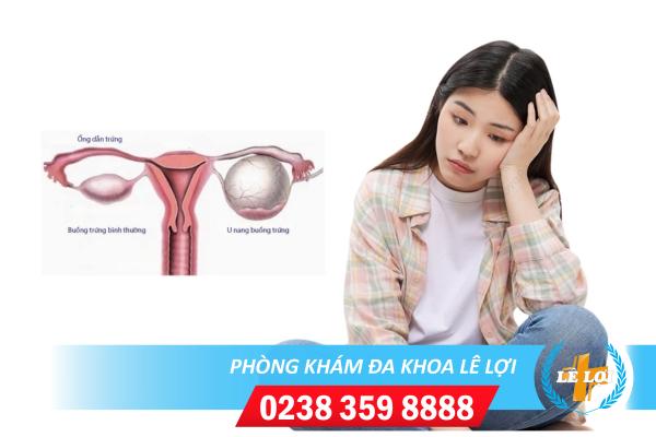 Địa chỉ Hỗ Trợ Chữa U Nang Buồng Trứng Ở Đâu Tốt?