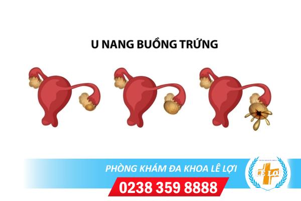 U Nang Buồng Trứng Là Gì? Triệu Chứng Và Cách Hỗ Trợ Điều Trị Hiệu Quả