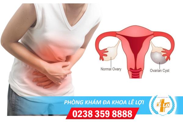 Tác Hại Của U Nang Buồng Trứng chị em cần biết