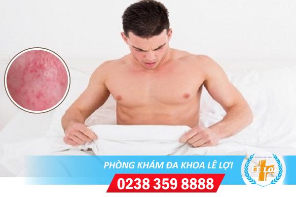Chi Phí Hỗ Trợ Chữa Hẹp Bao Quy Đầu Là Bao Nhiêu?