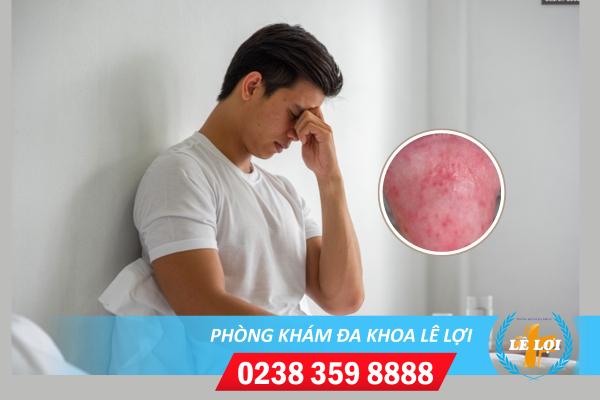 Chi Phí Hỗ Trợ Chữa Viêm Bao Quy Đầu Là Bao Nhiêu