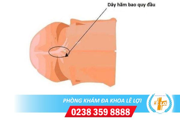 Đứt dây hãm bao quy đầu cần phải làm gì ?