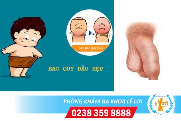 Hẹp bao quy đầu có ảnh hưởng gì đến sức khỏe sinh sản không ?