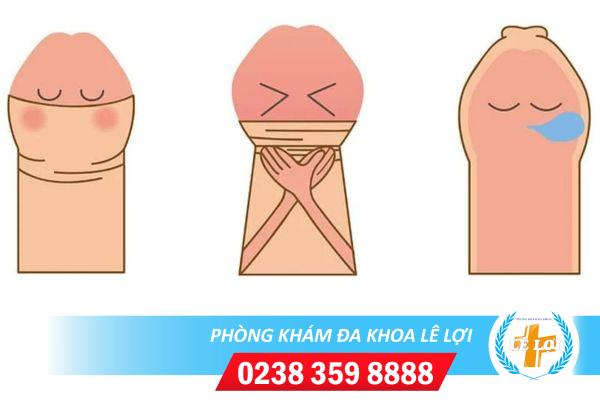 Thế nào là nghẹt bao quy đầu và cách xử lý khi bị nghẹt bao quy đầu