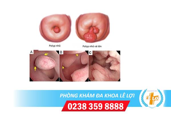 POLYP CỔ TỬ CUNG CÓ NGUY HIỂM KHÔNG?