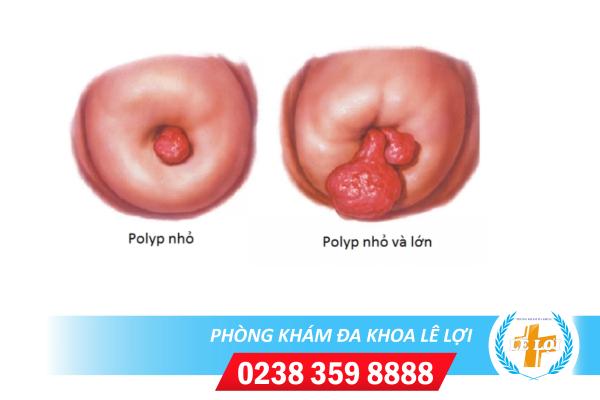 Biểu hiện nhận biết bệnh Polyp tử cung là gì và cách điều trị
