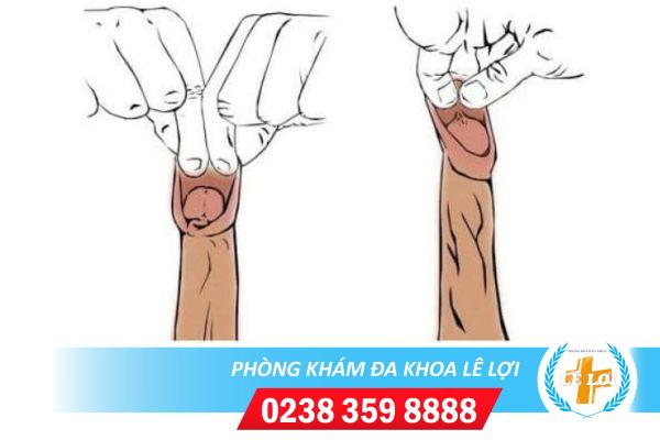 Thế nào là thừa bao quy đầu và có nên cắt bao quy đầu bị thừa không ?