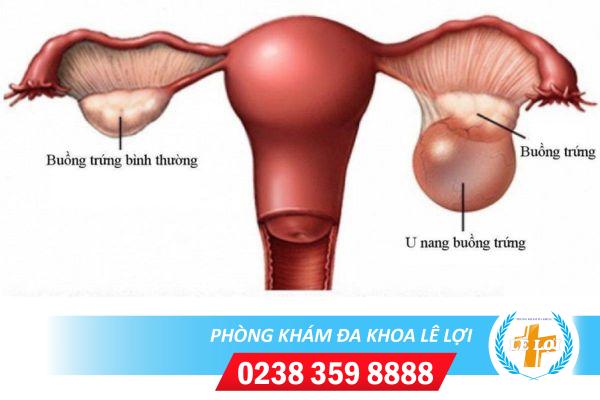 BỆNH U NANG TỬ CUNG NGUY HIỂM NHƯ THẾ NÀO?