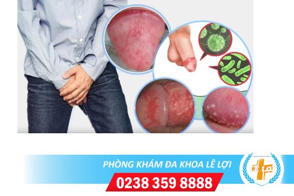 Các triệu chứng viêm bao quy đầu nguy hiểm nam giới nên biết