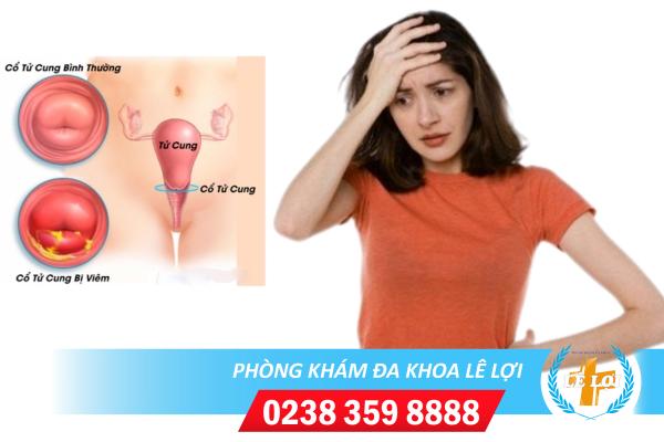 Nên Hỗ Trợ Điều Trị Viêm Cổ Tử Cung Ở Đâu Tốt Ở TP.VINH