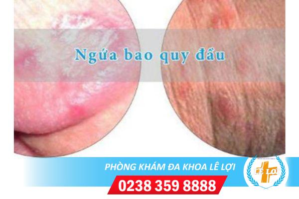 Ngứa bao quy đầu – đừng bao giờ bỏ qua