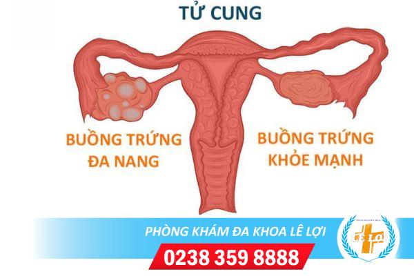 Cách phát hiện buồng trứng đa nang và giải pháp điều trị hiệu quả