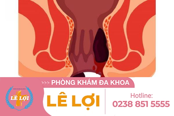Báo động đỏ khi ra máu hậu môn