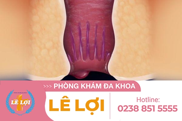 Hậu môn chảy mủ do đâu và cách điều trị hiệu quả