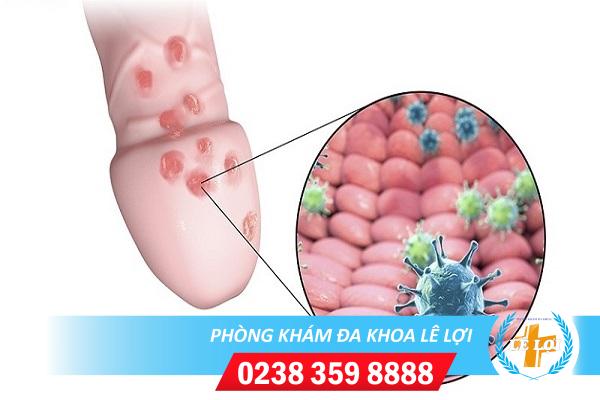 Triệu chứng của bệnh mụn rộp sinh dục ở nam