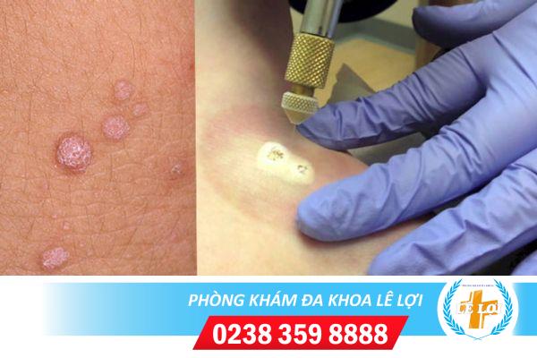 Phương pháp đốt sùi mào gà hiệu quả