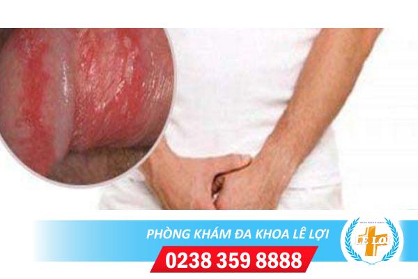 Dương vật bị loét nguyên nhân do đâu?