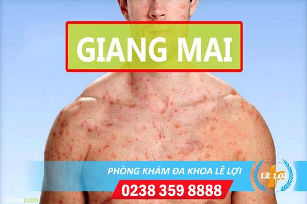 Triệu chứng bệnh giang mai qua từng giai đoạn