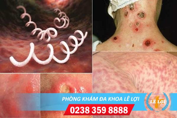 Chi phí hỗ trợ điều trị giang mai là bao nhiêu?