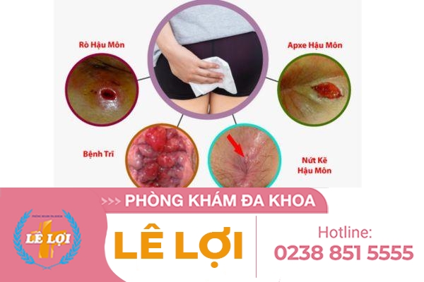 Lở loét hậu môn do đâu và cách điều trị