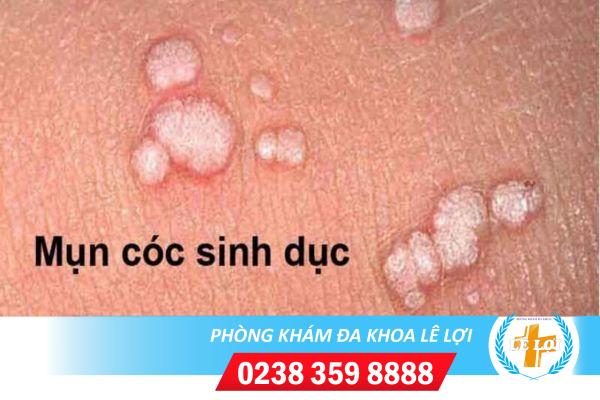 Mụn cóc sinh dục là bệnh gì?