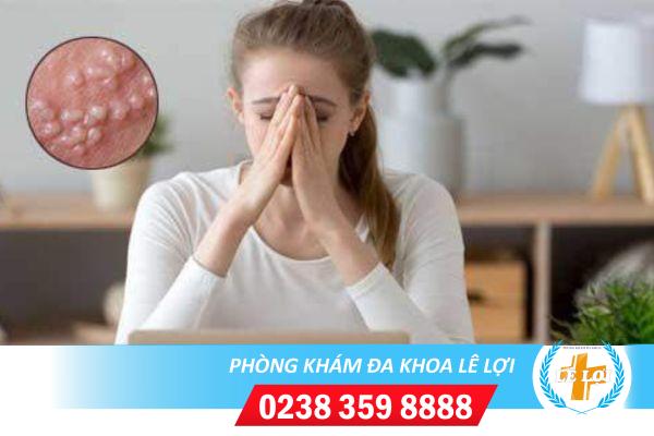 Mụn rộp sinh dục ở nữ nguy hiểm như thế nào?