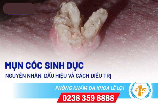 Mụn cóc sinh dục là bệnh gì ?