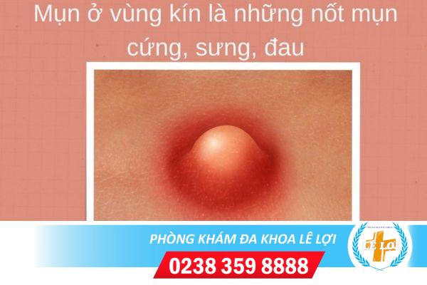 Nổi mụn ở vùng kín là bị bệnh gì?