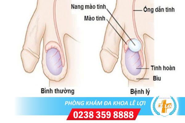 Viêm nang mào tinh hoàn là bệnh như thế nào?
