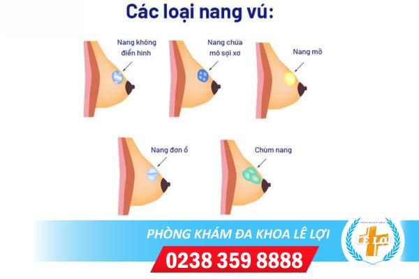 U nang tuyến vú và cách khắc phục