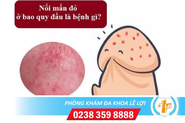 Quy đầu nổi mẫn đỏ ảnh hưởng đến sức khỏe như thế nào ?
