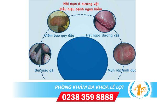 Dương vật mọc mụn có phải bị sùi mào gà không ?