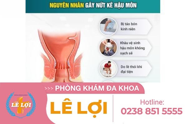 Nứt Kẽ Hậu Môn Là Gì Và Cách Hỗ Trợ Điều Trị Hiệu Quả