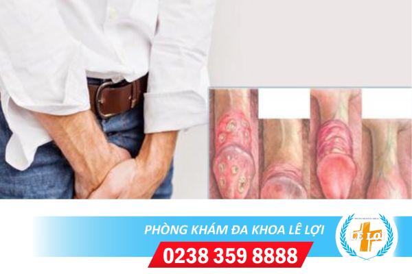 Dấu hiệu viêm quy đầu thường gặp