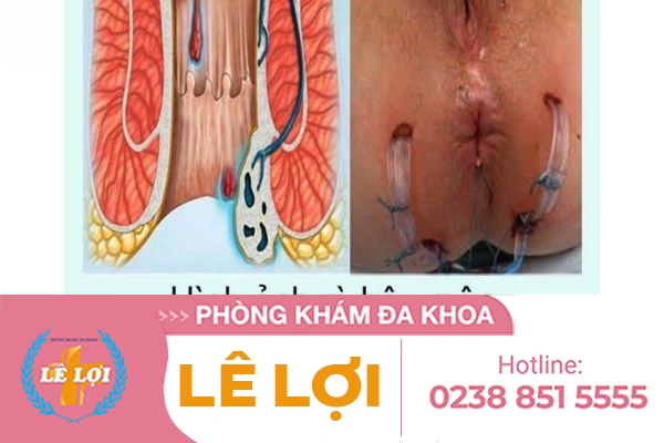 Bệnh Lý Rò Hậu Môn: Nguyên nhân, triệu chứng và cách điều trị hiệu quả