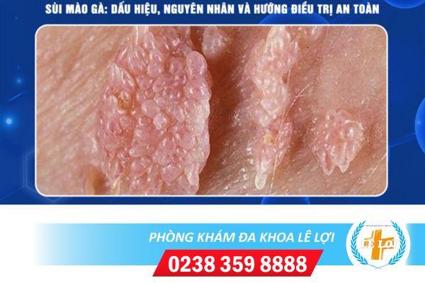 Bệnh sùi mào gà có khỏi được không?