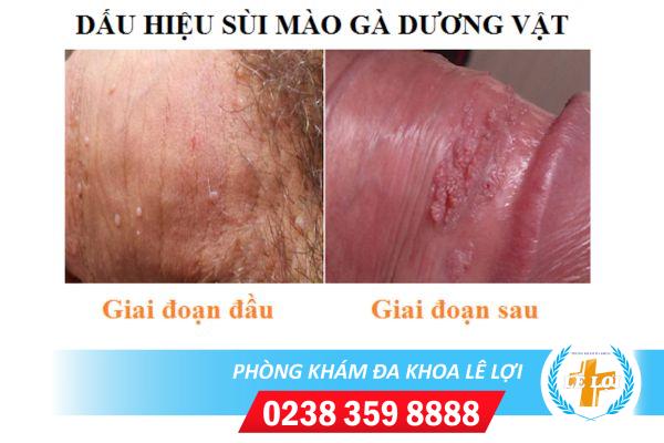 Bị vô sinh do mắc sùi mào gà ở dương vật