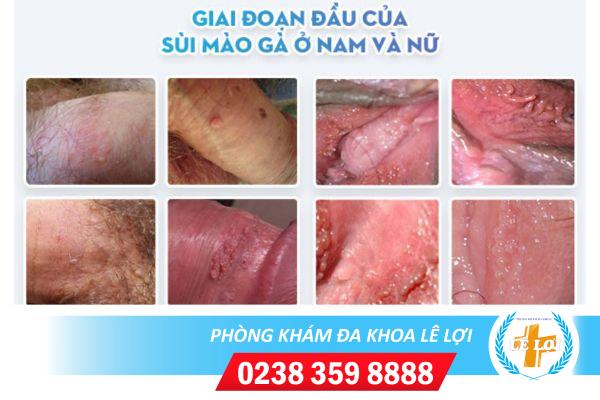 Sùi mào gà giai đoạn đầu như thế nào?