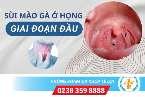 Sùi mào gà ở họng