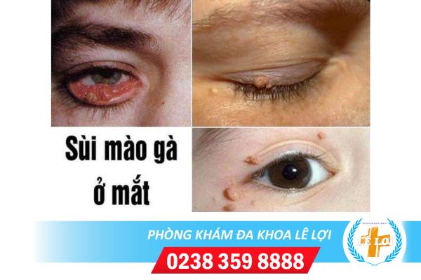 Bệnh sùi mào gà ở mắt