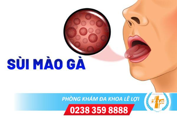 Thế nào là sùi mào gà ở lưỡi
