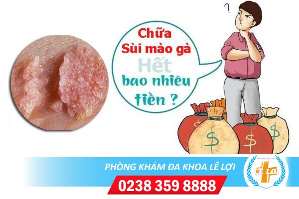 Chi phí chữa sùi mào gà tại Vinh hết bao nhiêu tiền?