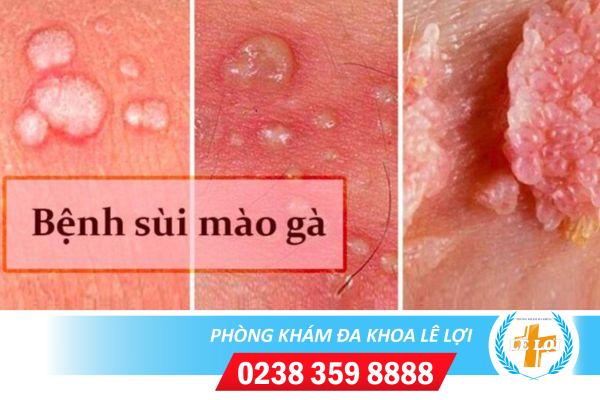 Bệnh sùi mào gà có khỏi được không ?