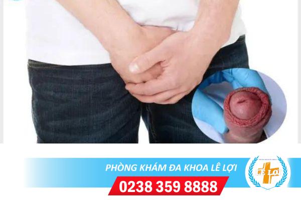 Quy đầu sưng đỏ phải đối mặt như thế nào ?