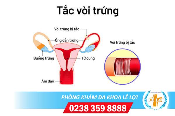 Địa chỉ thông tắc vòi trứng uy tín tại Nghệ An